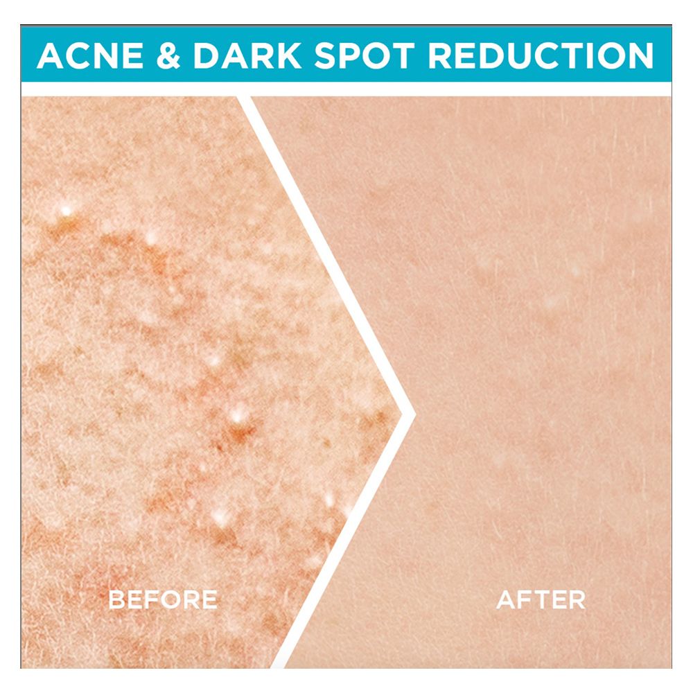 Garnier Bright Complete Anti-Acne Booster Serum